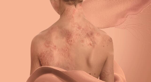 Así apoya Movistar a niños de Colombia que sufren la enfermedad Piel de Mariposa