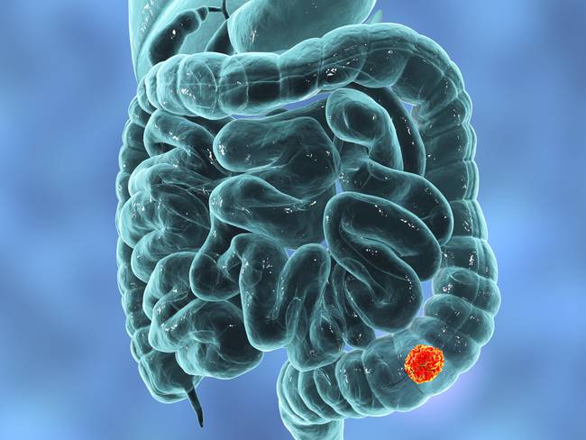 Científicos identifican células causantes de metástasis en el cáncer de colon