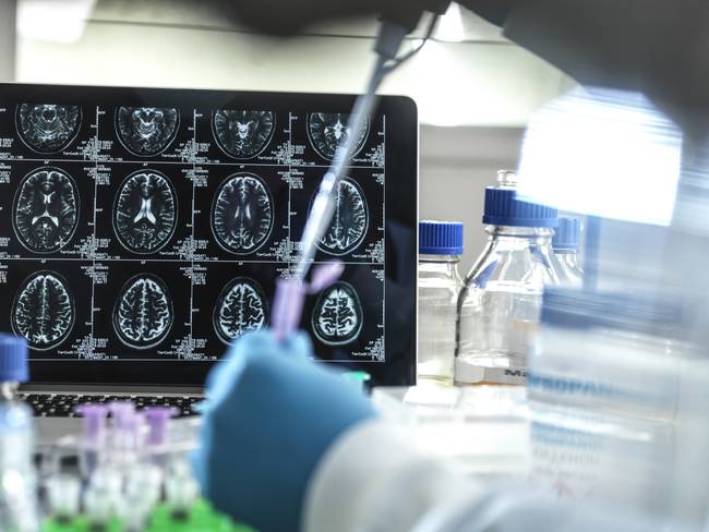 Alzheimer: farmacéutica confirma éxito de nuevo fármaco para ralentizarlo