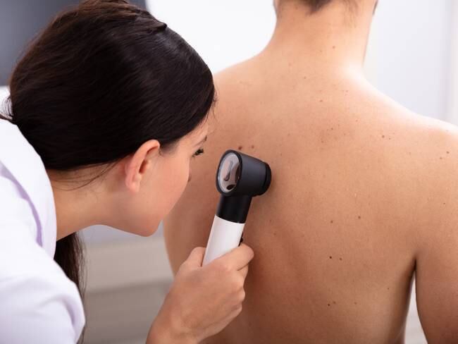 Imagen de referencia de cáncer en la piel. Foto: Getty Images.
