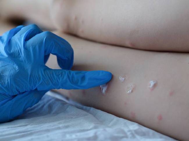 Viruela del mono/ Doctor in protective medical gloves applying cream to red rash of skin of child feet closeup. Diagnosis and treatment of chickenpox in children concept / Ivan-balvan