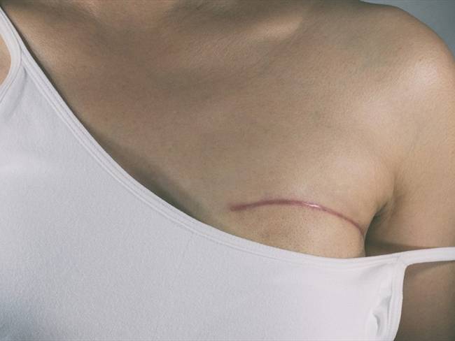 El 10% de colombianas se han hecho una mastectomía preventiva.. Foto: Getty Images