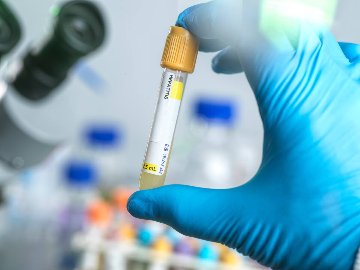 ¿Cuáles son los síntomas de la hepatitis? Experta entregó detalles de esta enfermedad