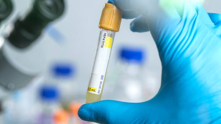 ¿Cuáles son los síntomas de la hepatitis? Experta entregó detalles de esta enfermedad
