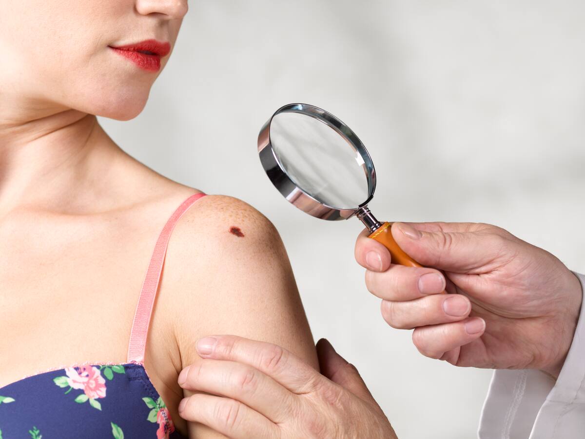 ¿Un lunar puede convertirse en un cáncer? Dermatóloga explicó