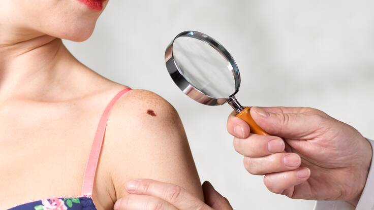¿Un lunar puede convertirse en un cáncer? Dermatologa explicó