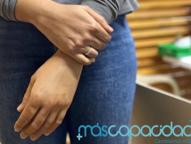 Soluciones W: Mujer recibirá prótesis para sus manos gracias a ‘MásCapacidad’