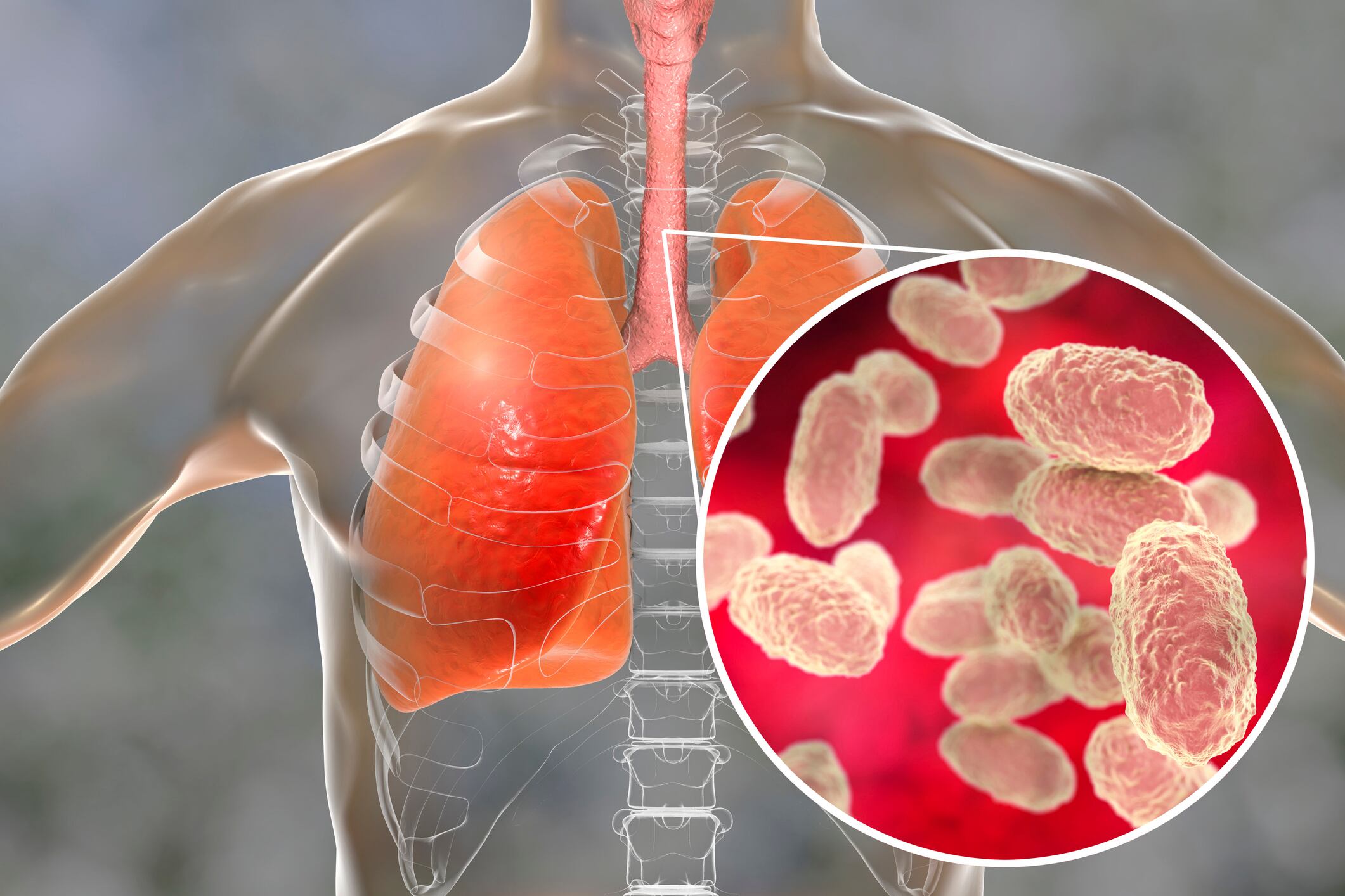 Tos ferina. Foto: Getty Images.