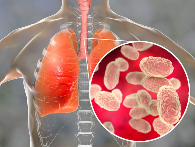 Tos ferina. Foto: Getty Images.