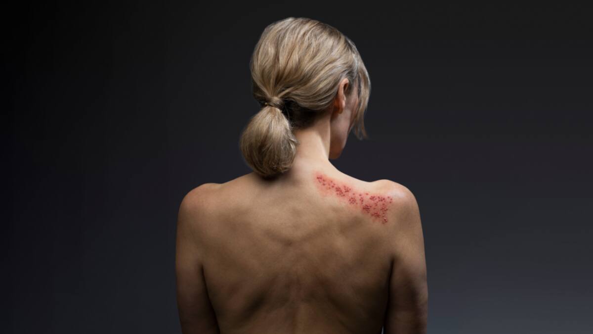 ¿Sabe qué es el herpes zóster o ‘culebrilla’? 99% de adultos con 50 años o más puede desarrollarlo