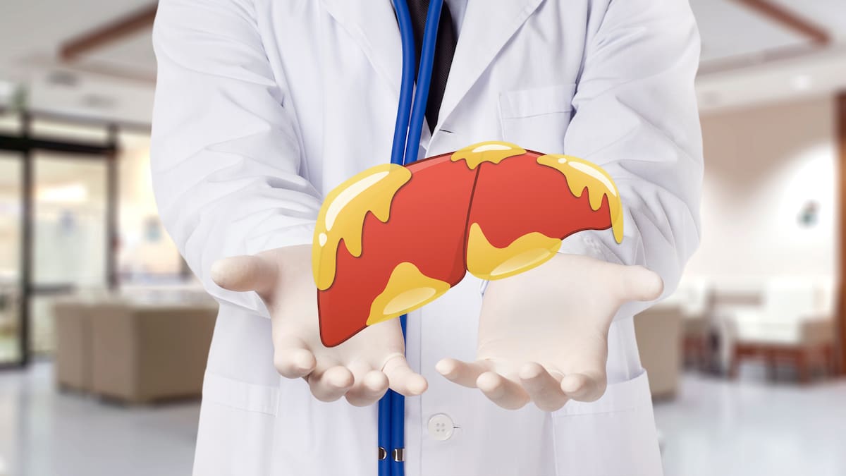 Higado graso: Experto habló de esta enfermedad silenciosa que llegar a ser muy grave