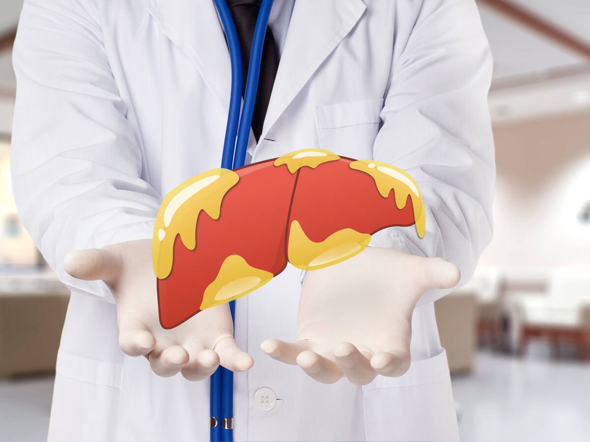 Hígado graso: experto habló de esta enfermedad silenciosa que llega a ser muy grave