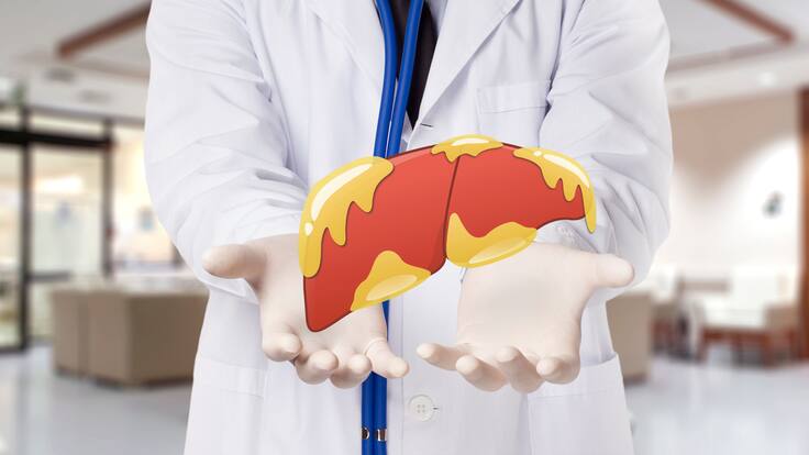 Higado graso: Experto habló de esta enfermedad silenciosa que llegar a ser muy grave