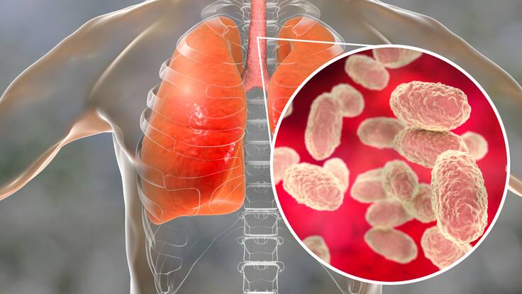 Tos ferina en Colombia: ¿Cómo se contagia y cuáles son los síntomas de alerta?