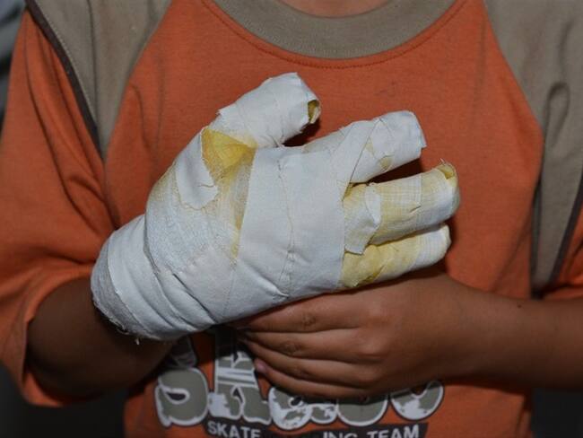 Del total de personas lesionadas con este tipo de elementos 20 son menores de edad. El municipio más afectado es Popayán con 12 casos, entre ellos ocho menores.. Foto: Colprensa