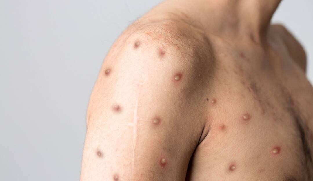 Imagen de referencia de la viruela del mono. Foto: Getty Images.