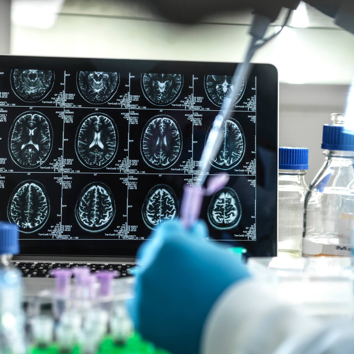 Lideran estudio de detección temprana de Alzheimer con una enzima especial llamada PHGDH