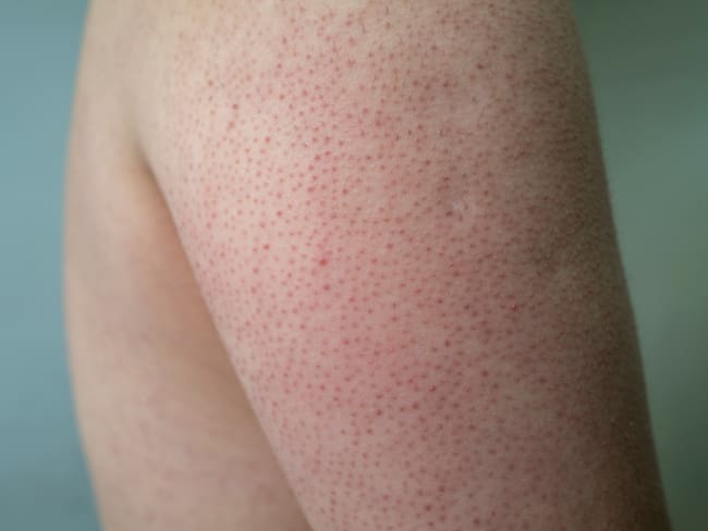 Keratosis pilaris