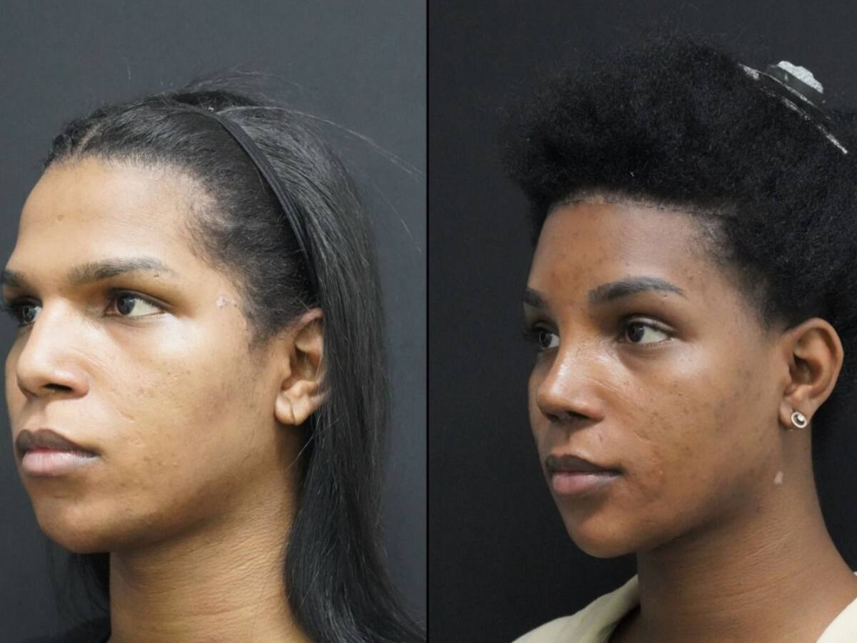 Feminización facial: así es el procedimiento para cambiar los rasgos de la cara