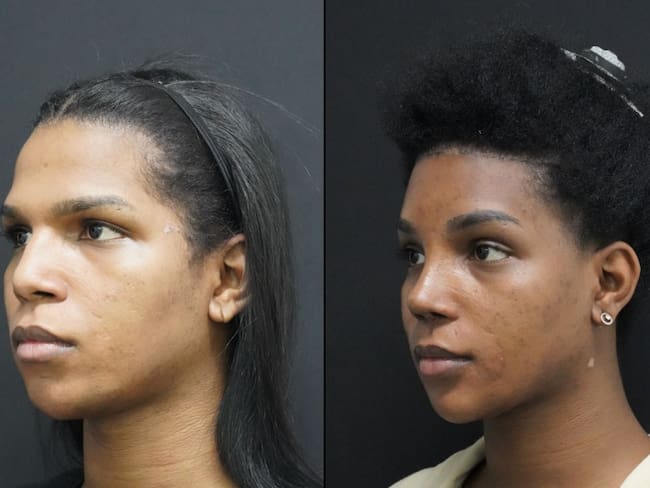 Feminización facial: así es el procedimiento para cambiar los rasgos de la cara