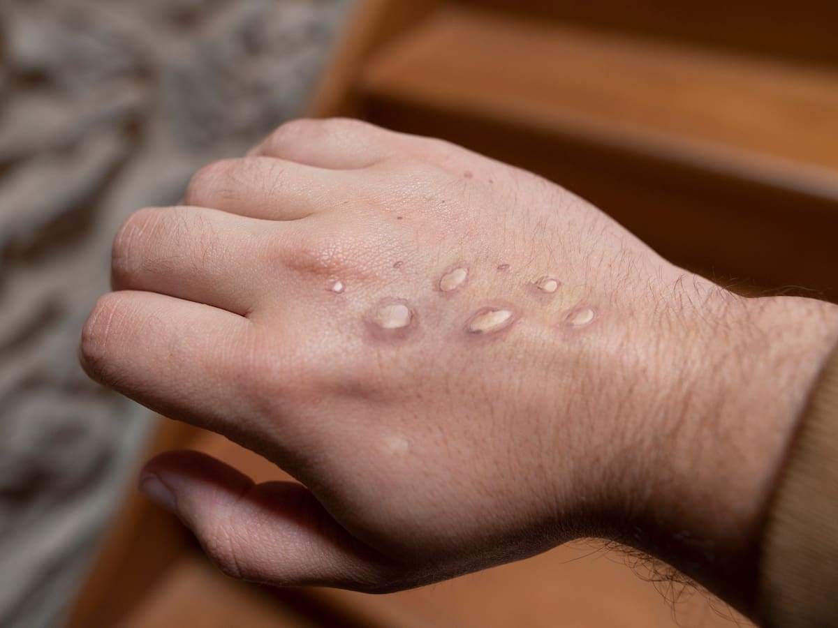 Bogotá presenta plan de prevención ante nueva variante de mpox