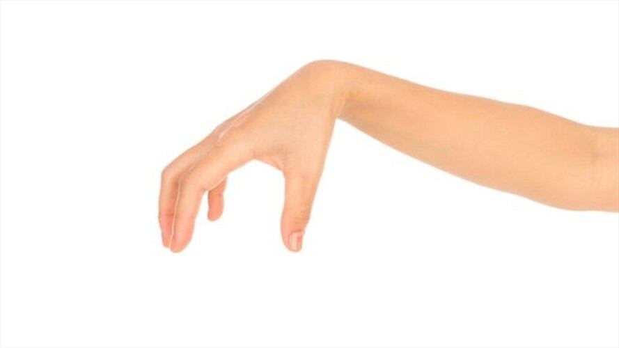 Quienes padecen la condición dicen que su mano no les obedece.. Foto: BBC Mundo