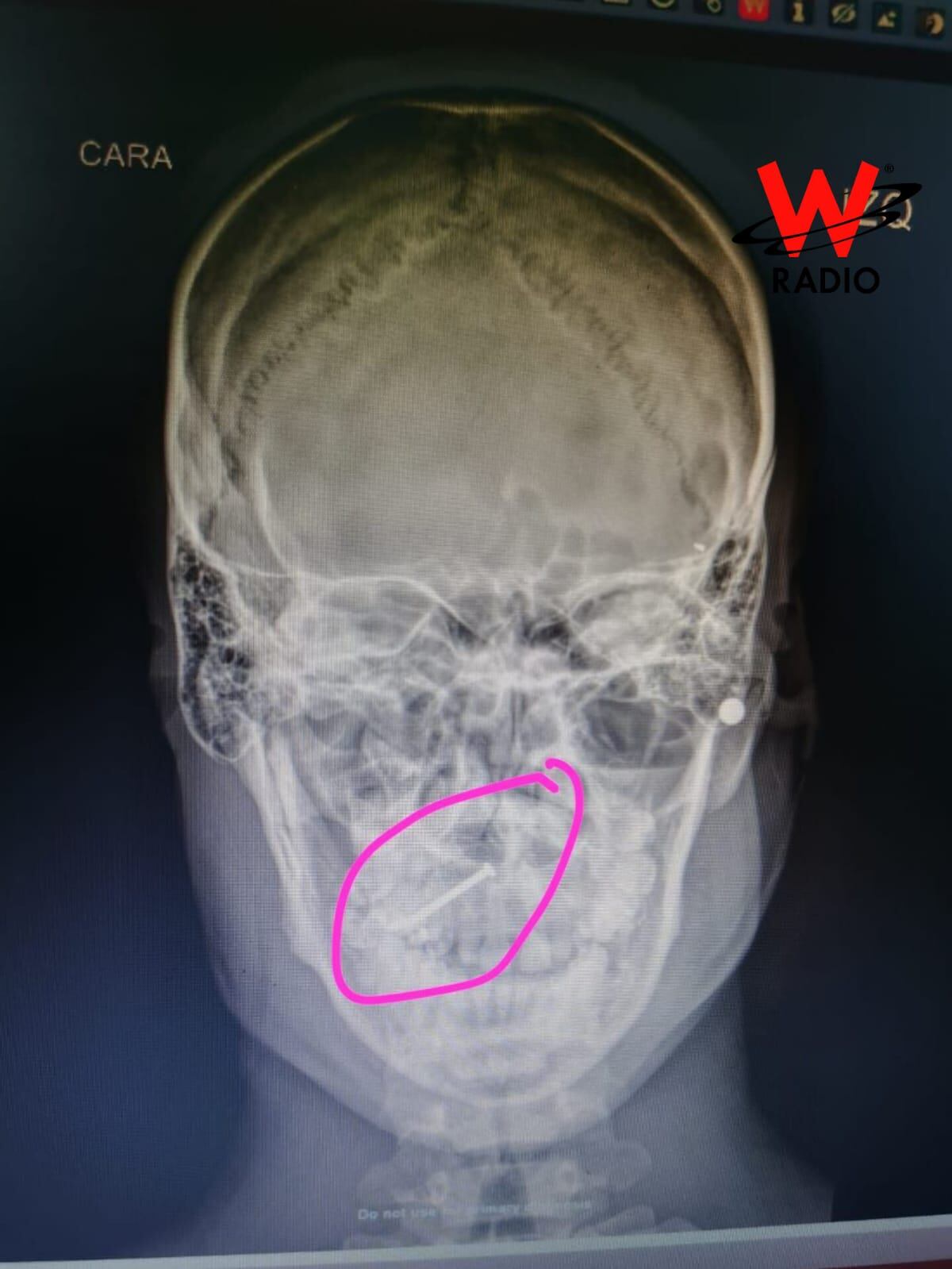 Tornillo en cráneo de militar tras ataque de las disidencias de las Farc. Foto: Ejército Nacional