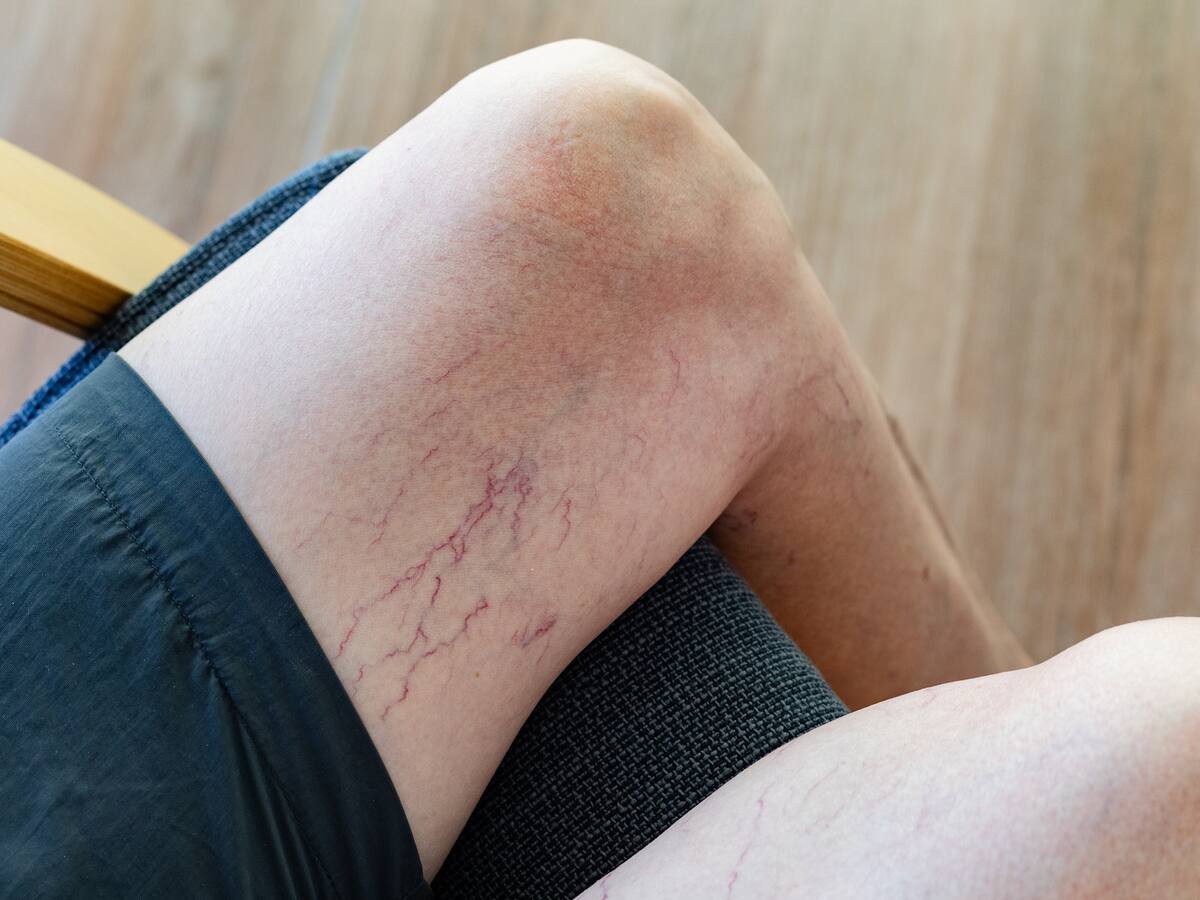 “Si ambos padres tienen varices, la probabilidad de desarrollarla es más del 80%”: Experta