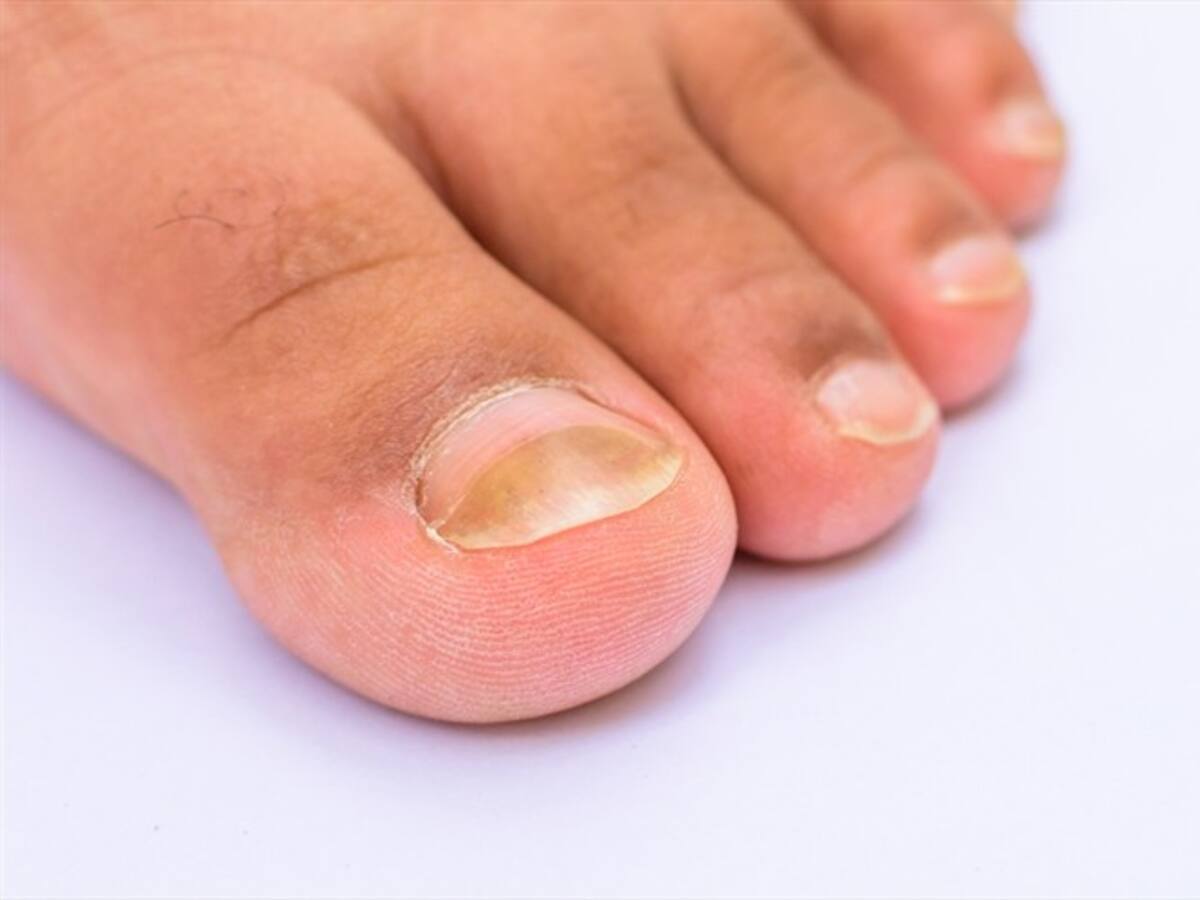 "Dedos de COVID", un nuevo y extraño signo del coronavirus