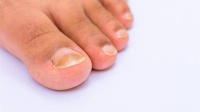 "Dedos de COVID", lo que sería un nuevo síntoma del coronavirus- Imagen de referencia. Foto: Getty Images