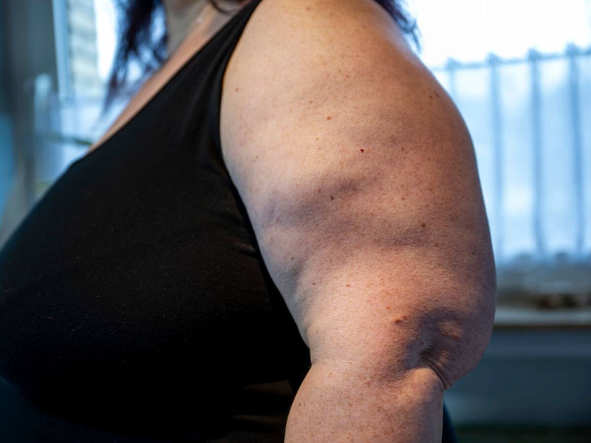 ¿Cuáles son las características del lipedema? Médico responde