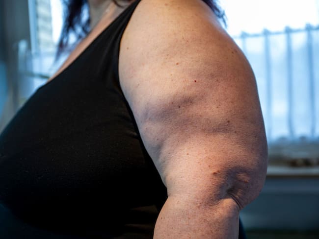 ¿Cuáles son las características del lipedema? Médico responde