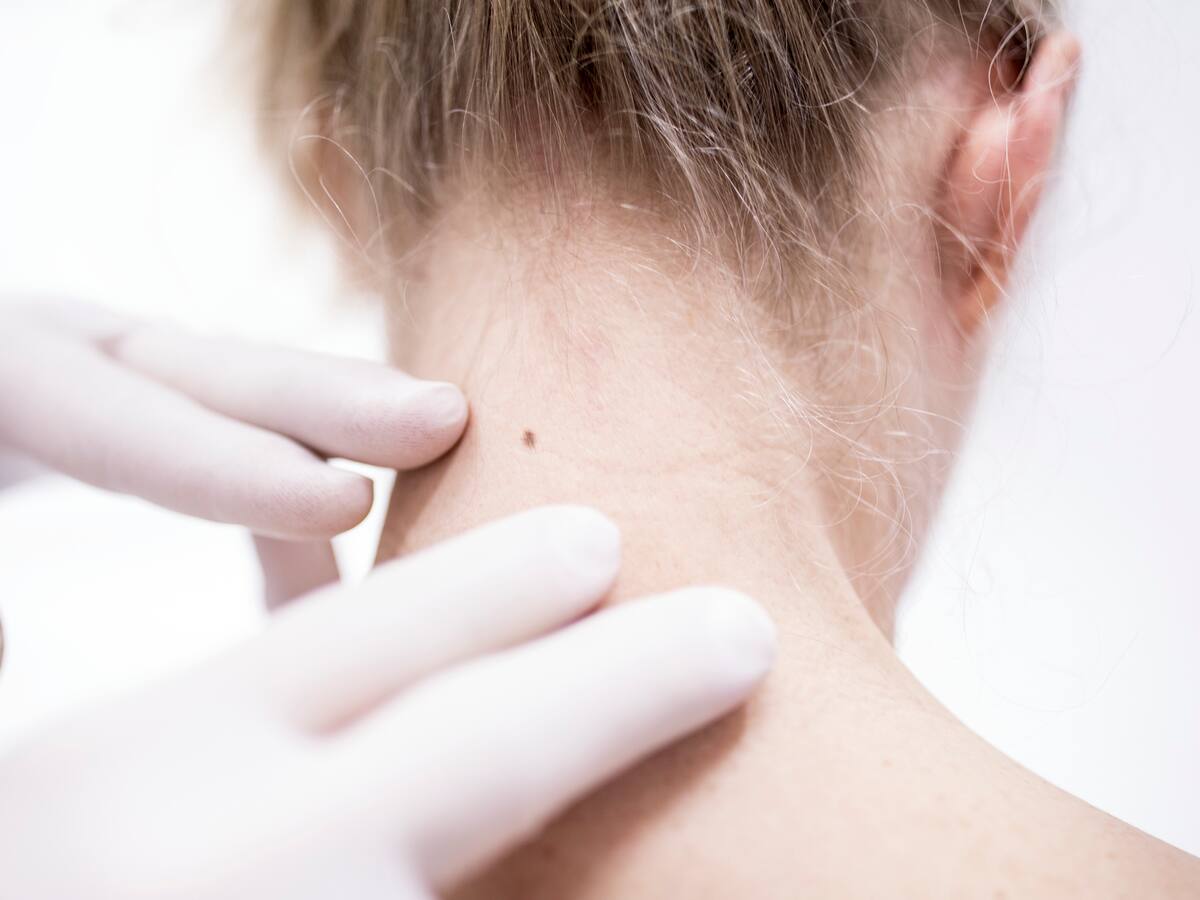 ¿El cáncer de piel puede hacer metástasis? Esto es lo que debe saber, según una experta