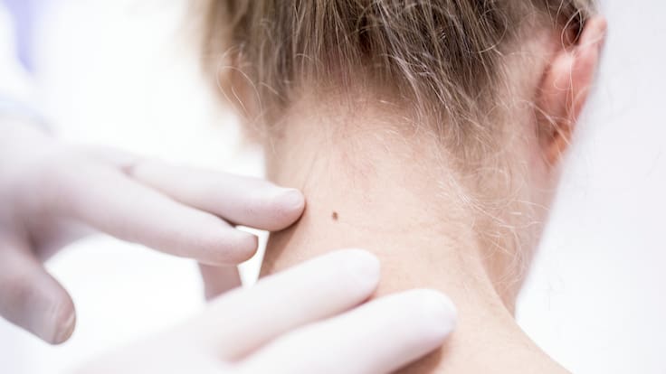 ¿El cáncer de piel puede hacer metástasis? Esto es lo que debe saber, según una experta