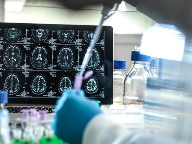 Se descubrió un segundo caso de resistencia al Alzheimer: ¿qué significa?