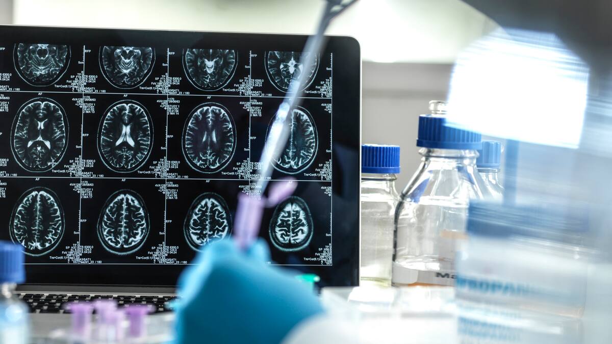 Se descubrió un segundo caso de resistencia al Alzheimer: ¿qué significa?