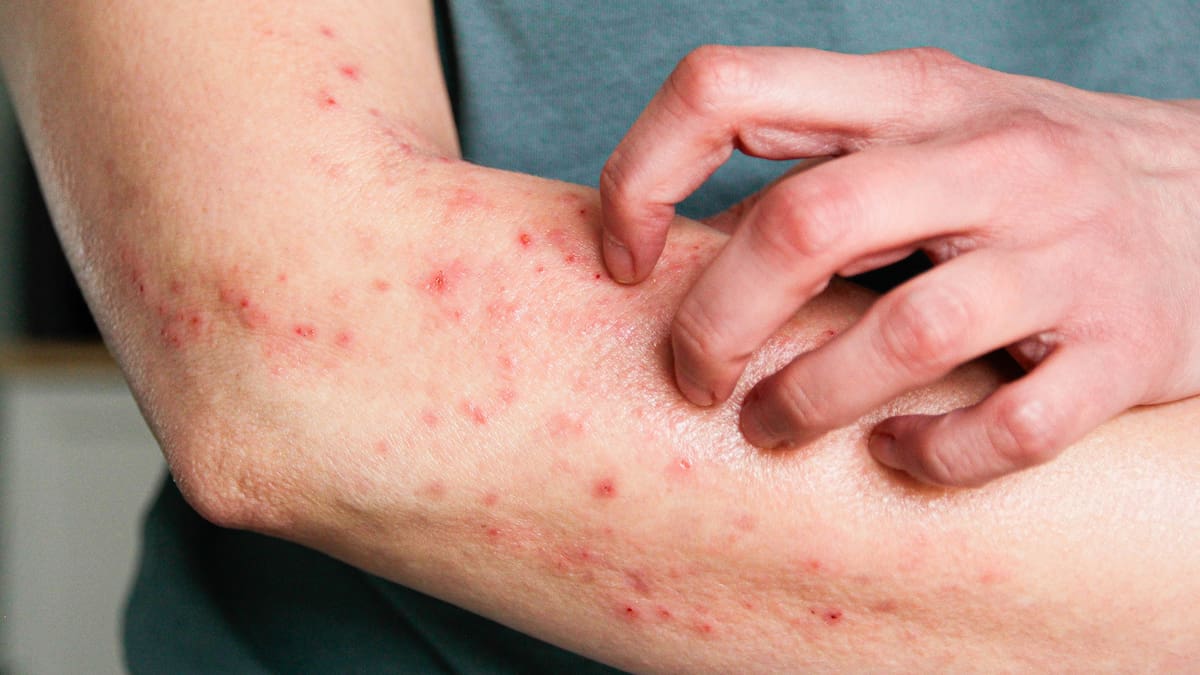 ¿Qué hacer frente a un ataque de alergia? Especialista de la salud explicó