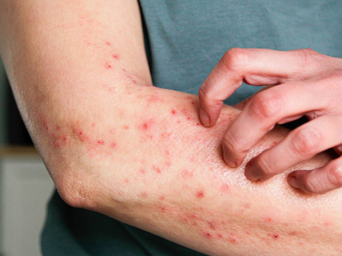 ¿Qué hacer frente a un ataque de alergia? Especialista de la salud explicó