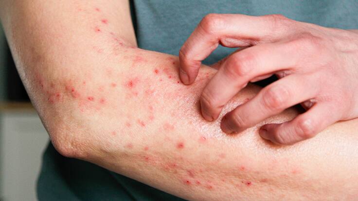 ¿Qué hacer frente a un ataque de alergia? Especialista de la salud explicó