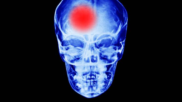 Estas son algunas recomendaciones para manejar una convulsión, según neuróloga