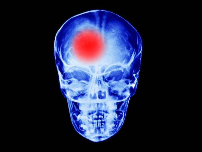 Estas son algunas recomendaciones para manejar una convulsión, según neuróloga