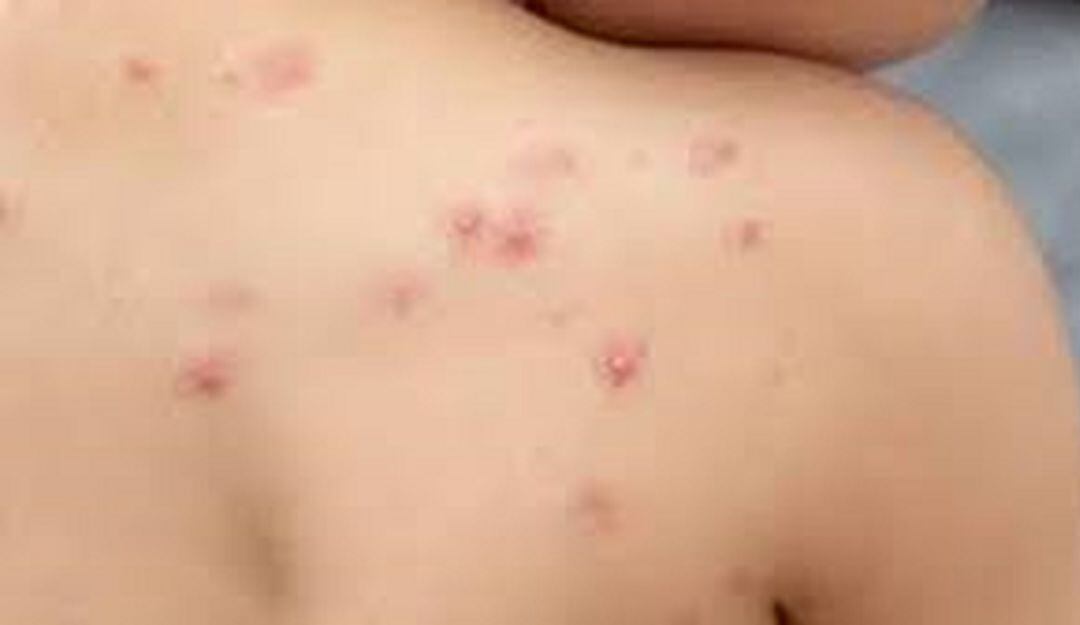 En Córdoba no se han presentado casos confirmados de Mpox clado 1: Gobernación.