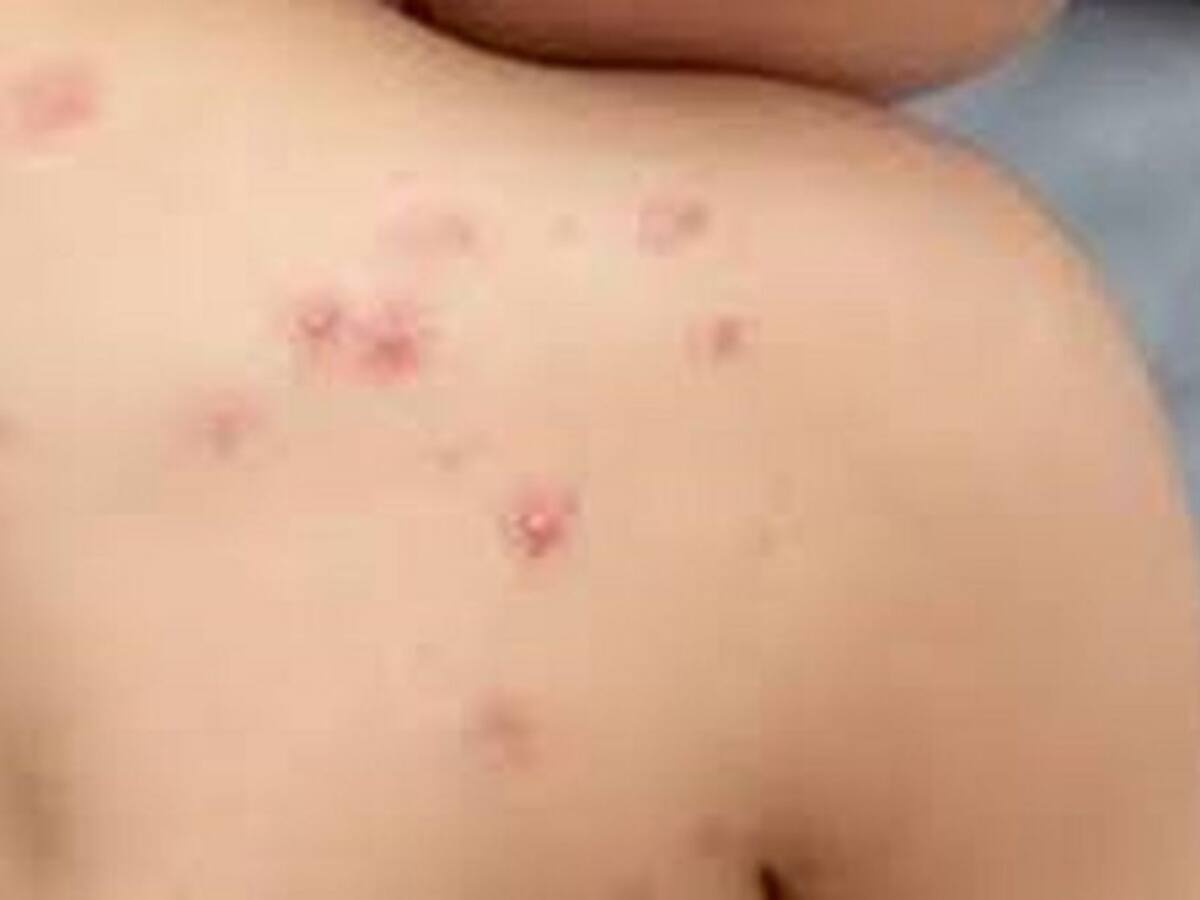 En Córdoba no se han presentado casos confirmados de Mpox clado 1: Gobernación