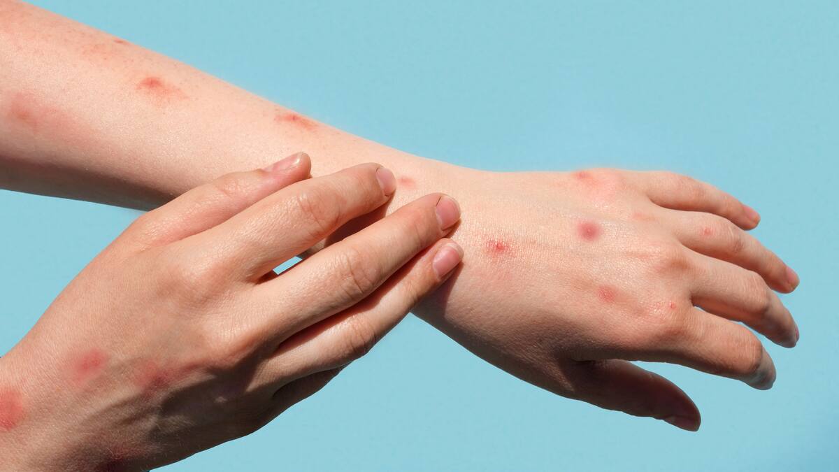 ¿Cómo prevenir la infección de la viruela del mono?