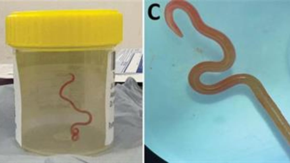 Lombriz intestinal viva de casi 8 centímetros. Foto: EFE.