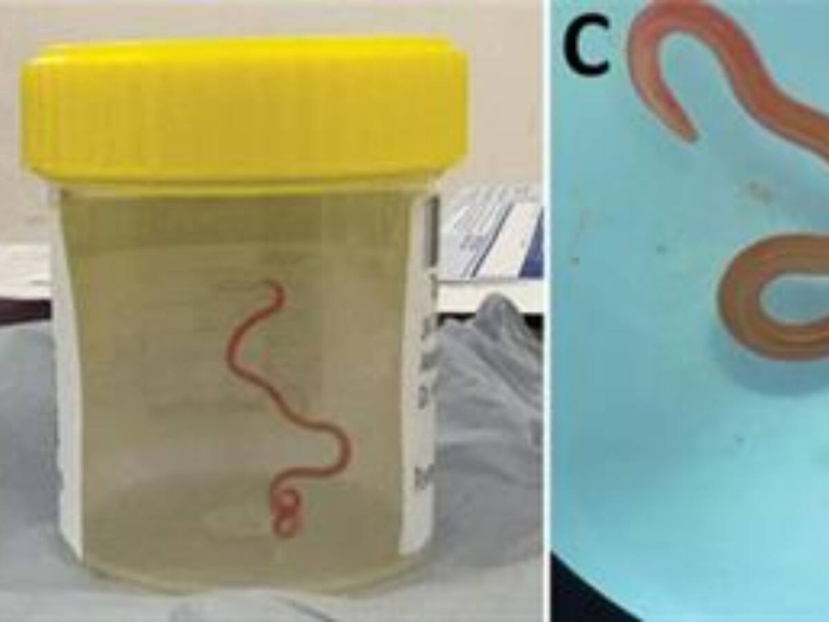 Extraen una lombriz intestinal viva de casi 8 centímetros del cerebro de una mujer