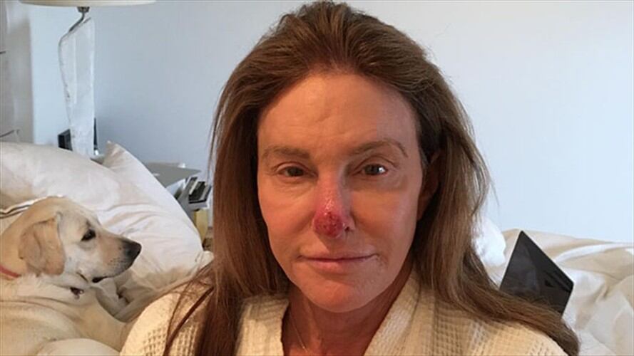 Caitlyn Jenner tuvo que pasar por quirófano para eliminar un carcinoma de su nariz. Foto: Bang Media