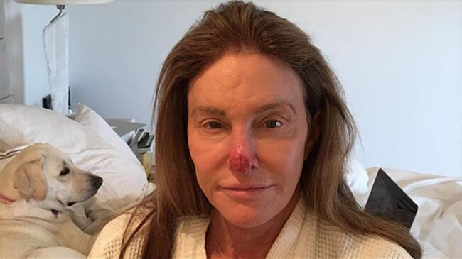 Caitlyn Jenner tuvo que pasar por quirófano para eliminar un carcinoma de su nariz. Foto: Bang Media