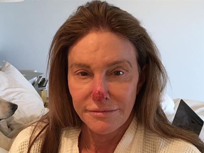 Caitlyn Jenner tuvo que pasar por quirófano para eliminar un carcinoma de su nariz. Foto: Bang Media