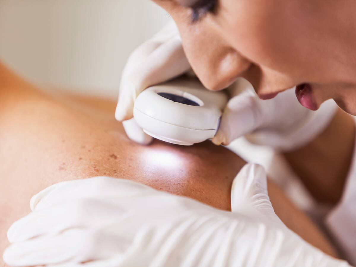 ¿Cómo es la cirugía de reconstrucción para pacientes de cáncer de piel? Experto explicó